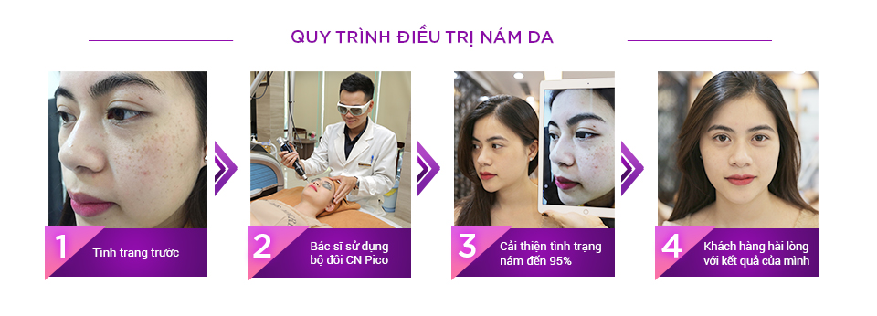 Cách trị nám da mặt bằng Laser PicoSure và PicoWay